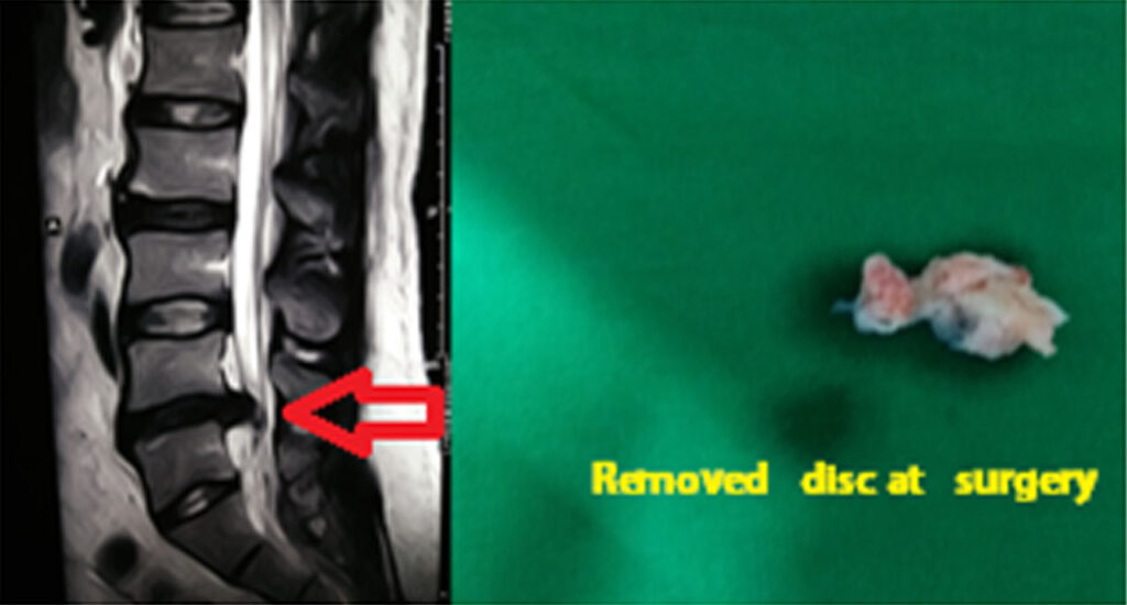 Lumbar Disc Prolapse Dr. Kaushik Sil
